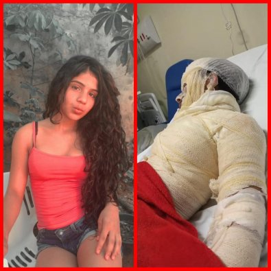 Menina queimadura montagem / Folhamax 