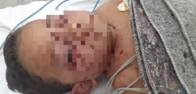 Criança é atacada por cachorro no quintal de vizinho em MT
