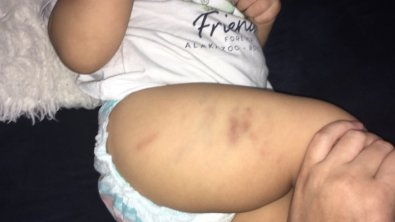 bebe-hematomas.jpg
