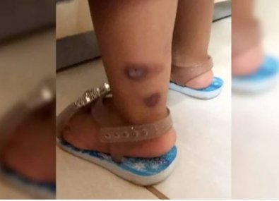 bebe queimadura.JPG