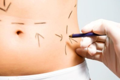 cirurgia plastica, lipoaspiracao, lipo
