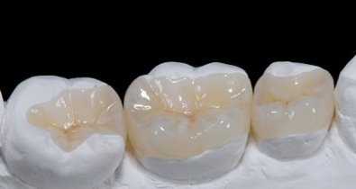 onlay-inlay3.jpg