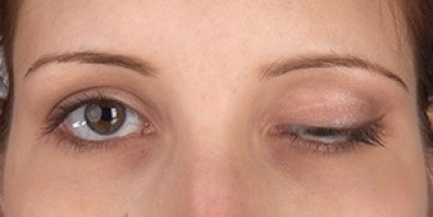 botox-torto.jpeg