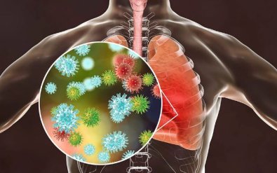 pneumonia.JPG