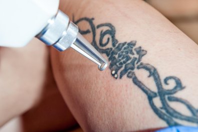 TATUAGEM-REMOCAO.jpg