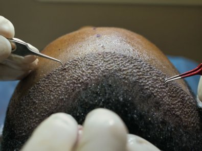 TRANSPLANTECAPILAR.jpg