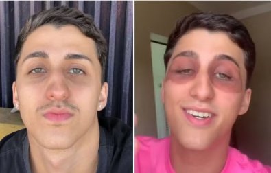 olho roxo.jpg