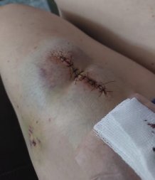 medica carolina biscaia, cirurgia fake cancer