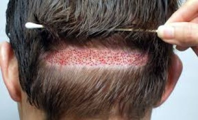 IMPALNTE-CABELO.jpg