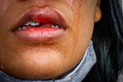 mulher dente quebrado