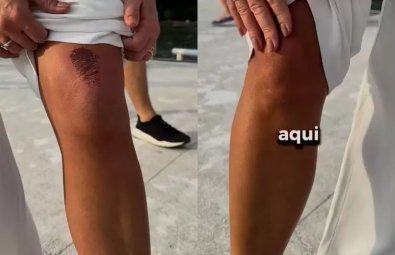 prefeita atropelada