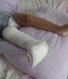 CRIANCA PERNA QUEBRADA.jpg
