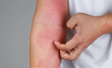 DERMATITE.jpg