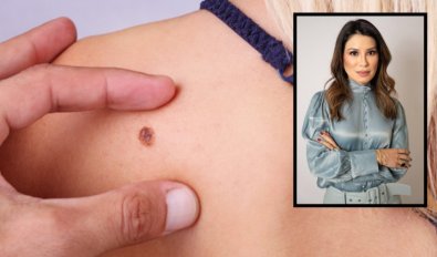 melanoma.jpg