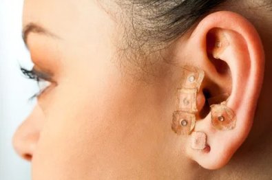 auriculoterapia.jpg
