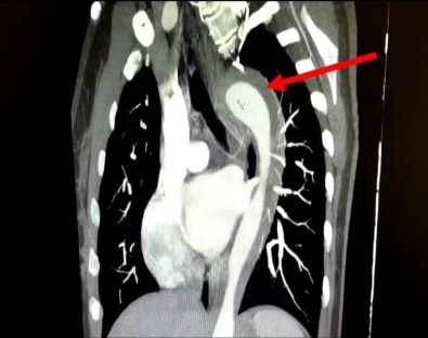 AORTA ROMPIDA-ORGASMO.jpg
