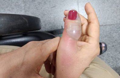 infeccao-unhas.jpg