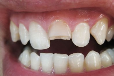 dente quebrado